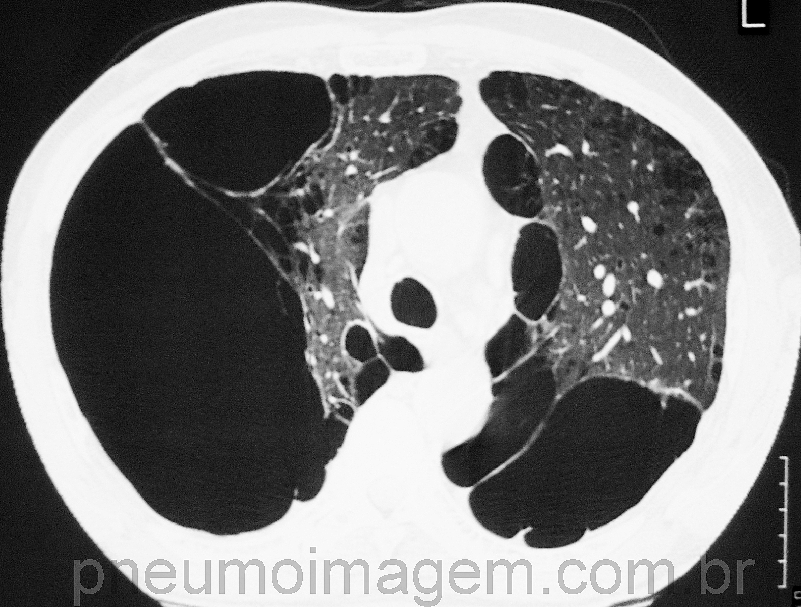 COMBINA��O VILANTEROL/FLUTICASONA N�O REDUZ MORTALIDADE EM DPOC, APONTA ESTUDO